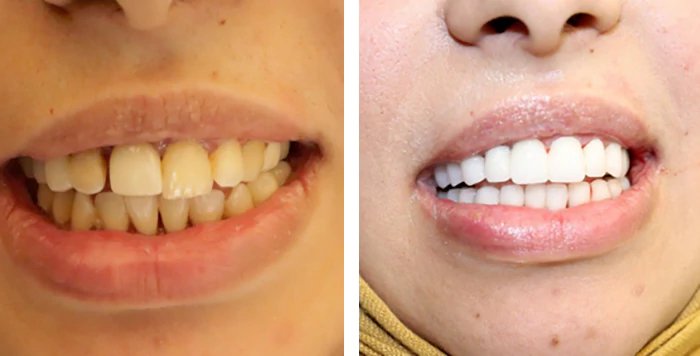 before & after photo of Dental Implant