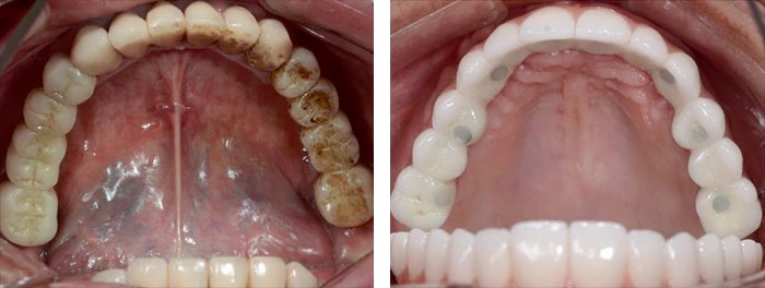 before & after photo of Dental Implant