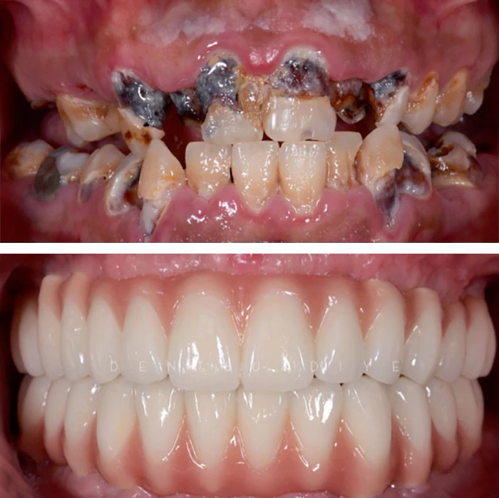 before & after photo of زراعة الأسنان