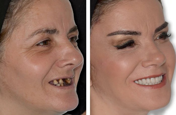 before & after photo of Dental Implant