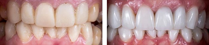 before & after photo of Teeth Whitening