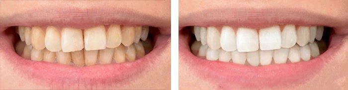 before & after photo of Teeth Whitening