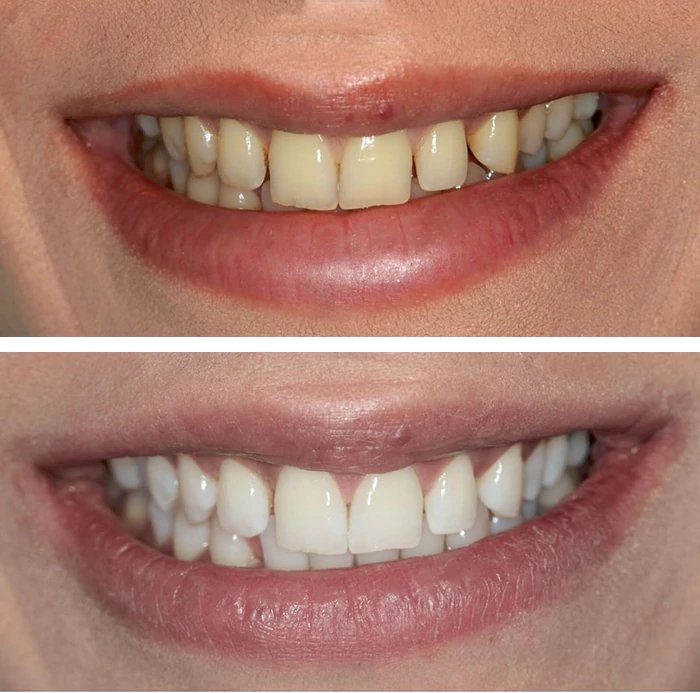 before & after photo of Teeth Whitening