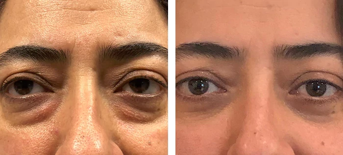 before & after photo of عملية تجميل الجفون