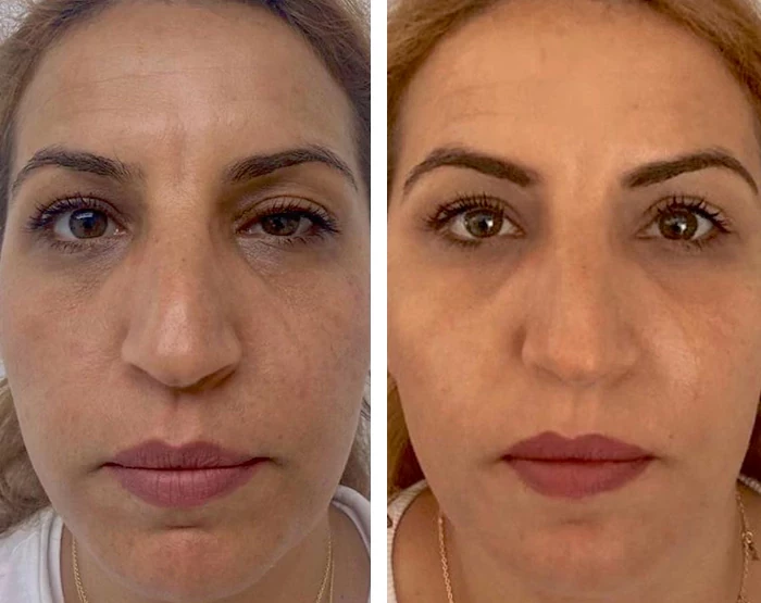 before & after photo of عملية تجميل الجفون