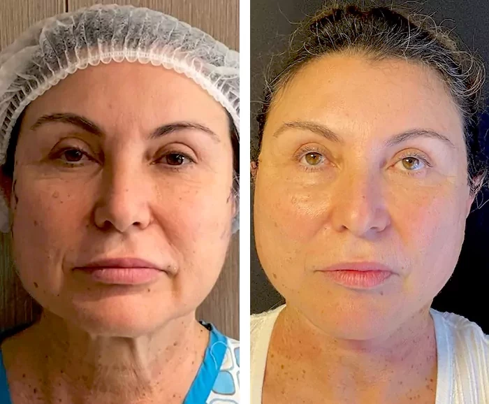 before & after photo of Facelift