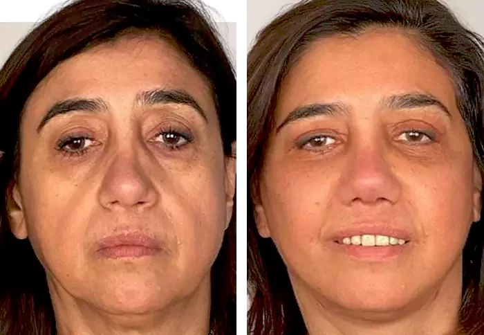 before & after photo of عملية تجميل الأنف