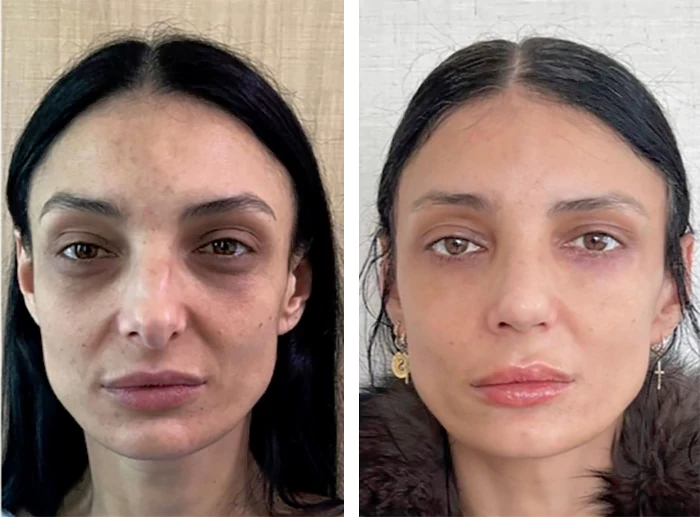 before & after photo of عملية تجميل الأنف