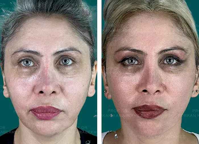 before & after photo of عملية تجميل الأنف