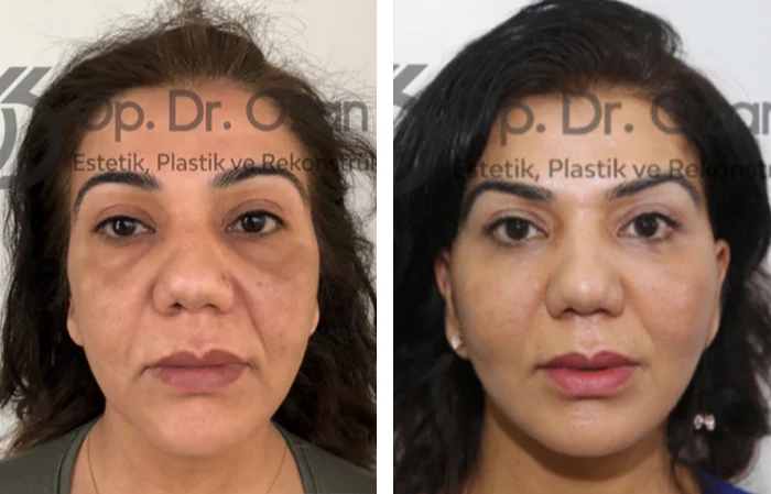 before & after photo of عملية تجميل الأنف