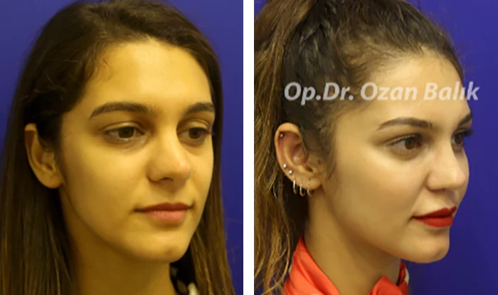 before & after photo of Facial Fat Transfer