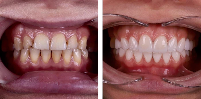 before & after photo of dental-implant
