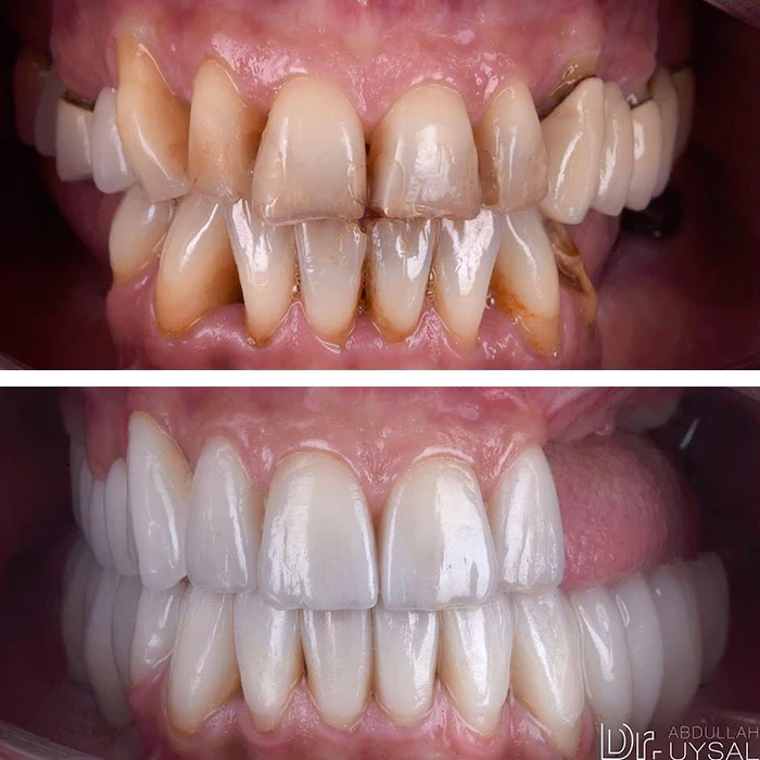 before & after photo of زراعة الأسنان