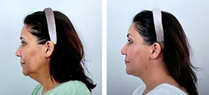 before & after photo of Rhinoplasty