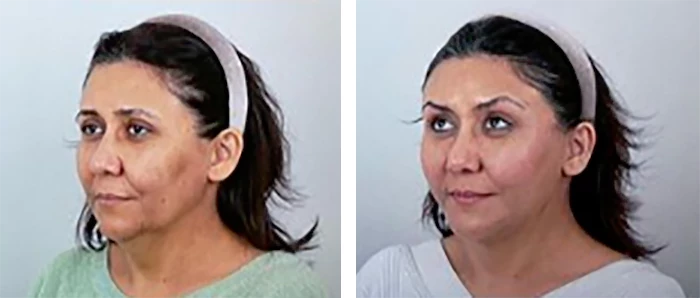 before & after photo of Thread Lift
