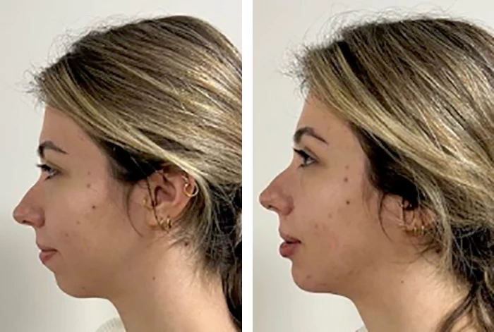 before & after photo of jaw-surgery