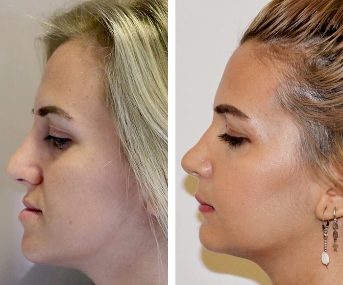before & after photo of jaw-surgery