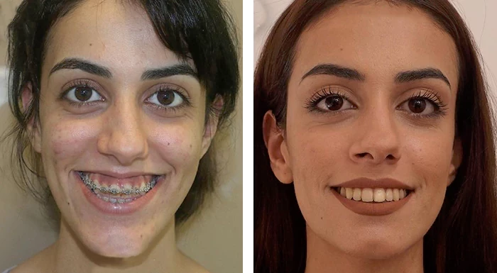 before & after photo of Jaw Surgery