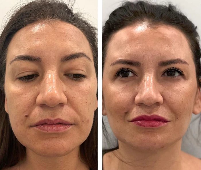 before & after photo of Lip Filler