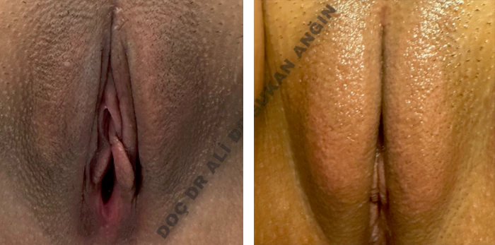 before & after photo of Labiaplasty