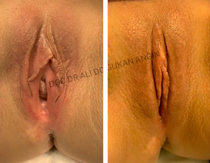 before & after photo of Perineoplasty