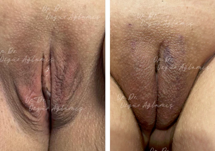 before & after photo of تجميل الشفرين