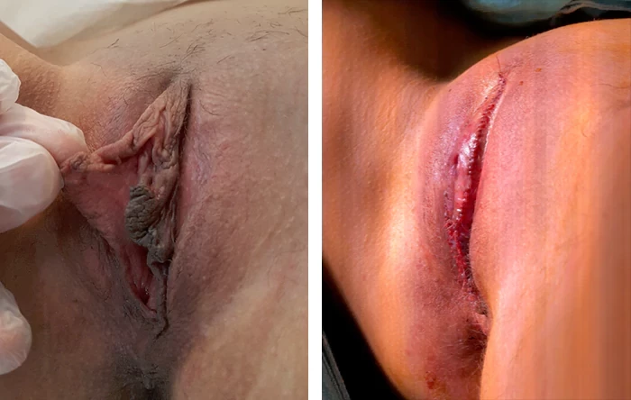 before & after photo of تجميل الشفرين