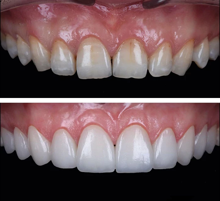 before & after photo of فينير الأسنان