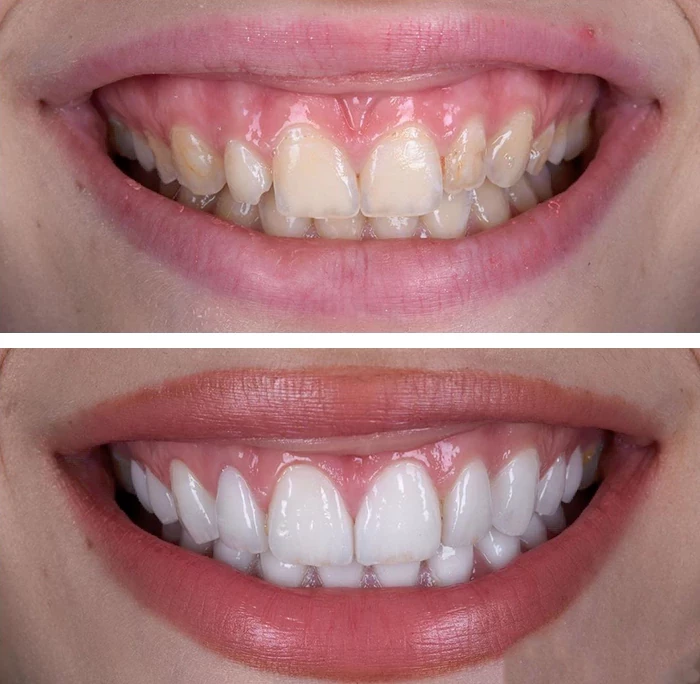 before & after photo of dental-veneers