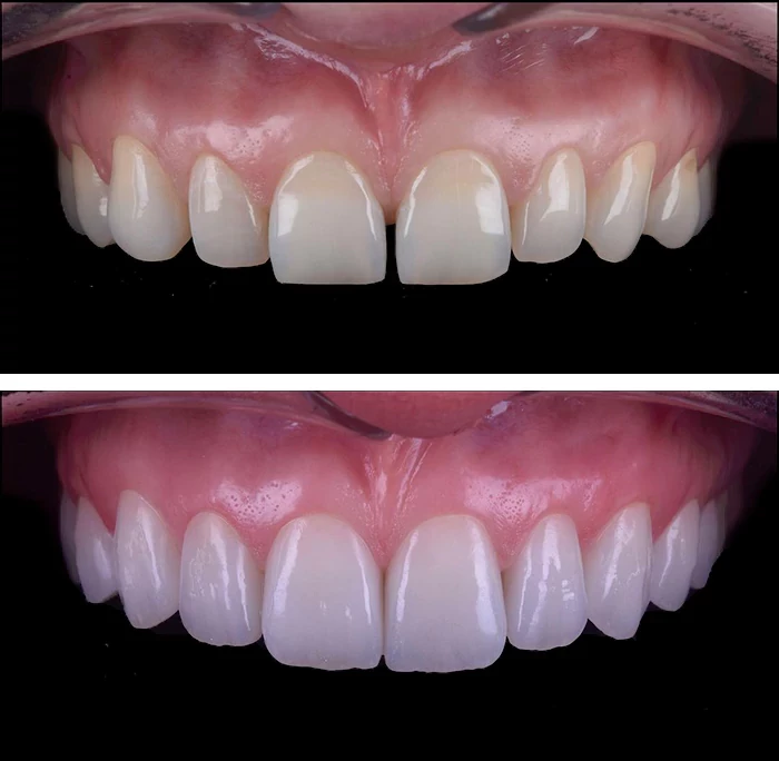before & after photo of فينير الأسنان