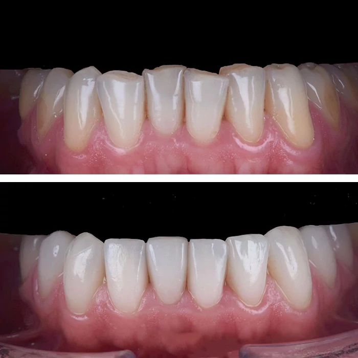 before & after photo of فينير الأسنان