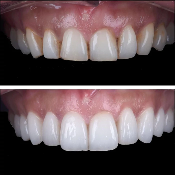 before & after photo of فينير الأسنان