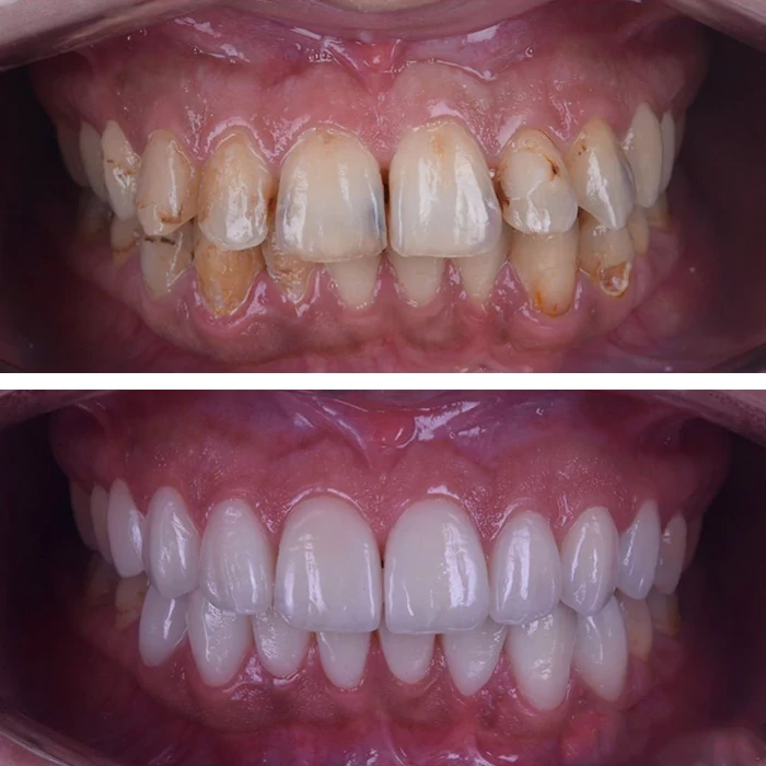 before & after photo of فينير الأسنان