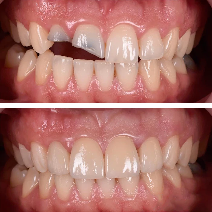 before & after photo of فينير الأسنان