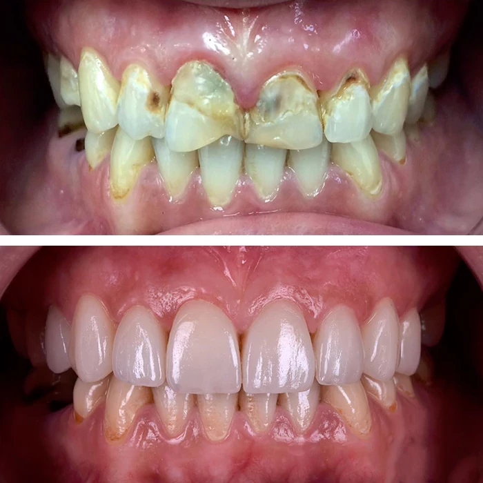 before & after photo of فينير الأسنان