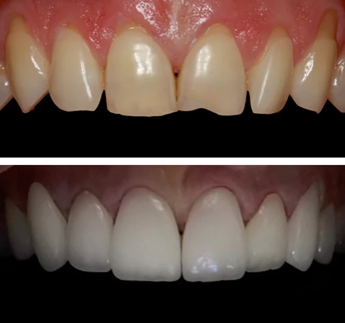 before & after photo of فينير الأسنان