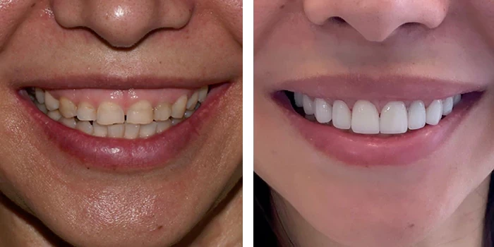 before & after photo of Dental Veneers