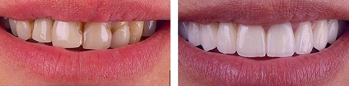 before & after photo of Dental Veneers