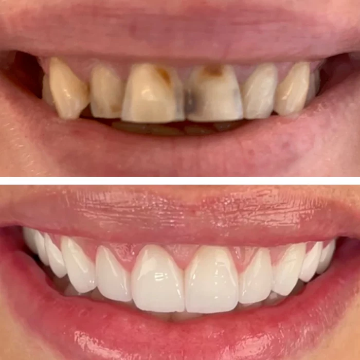 before & after photo of Dental Veneers