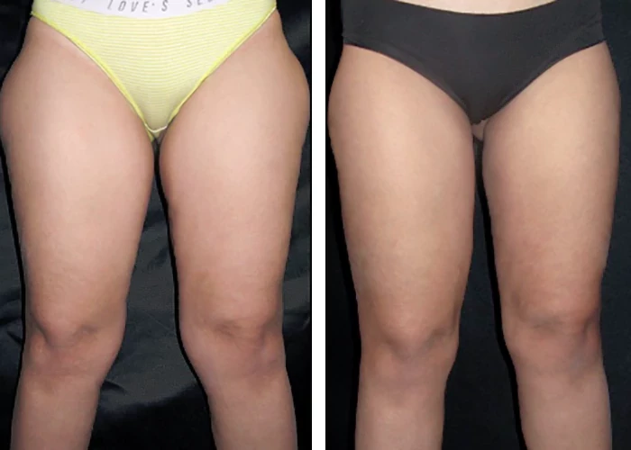 before & after photo of Thigh Lift