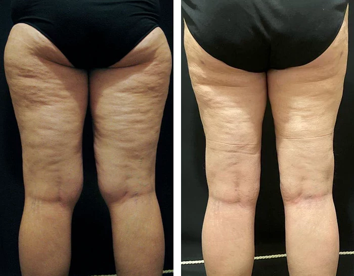 before & after photo of Thigh Lift