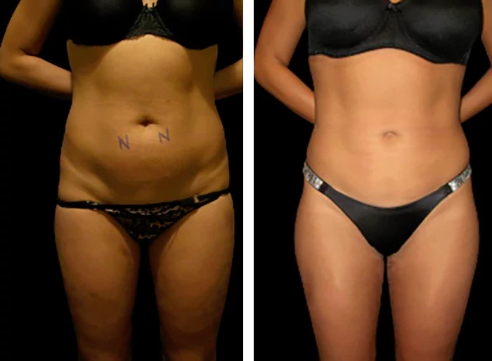 before & after photo of Thigh Lift