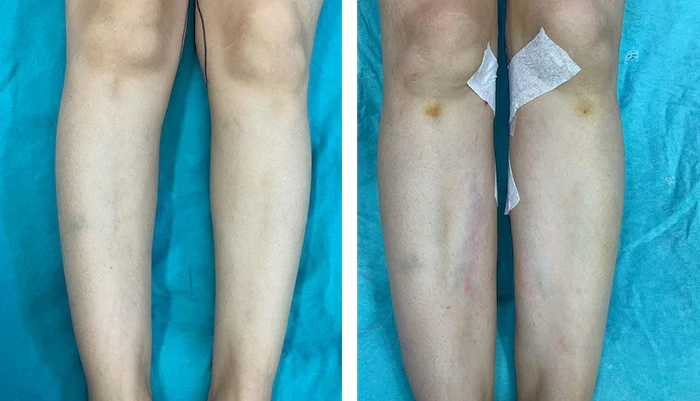 before & after photo of thigh-lift