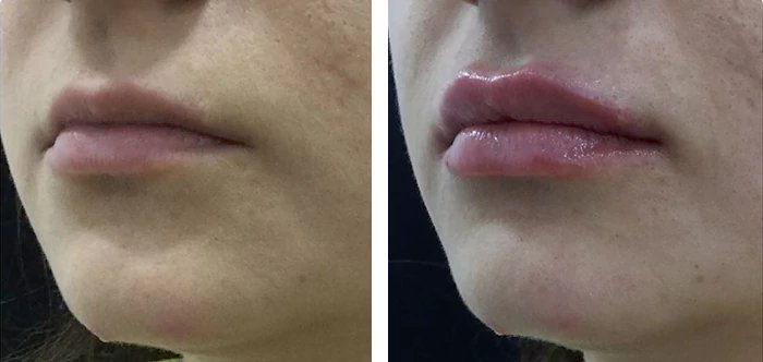 before & after photo of Lip Filler