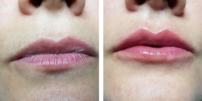 before & after photo of Nose Filler