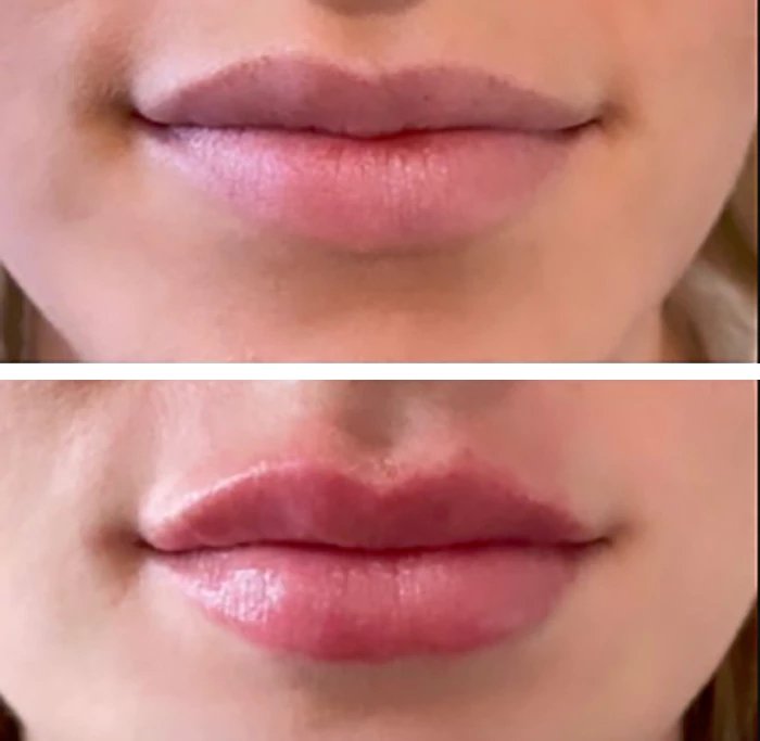 before & after photo of Nose Filler