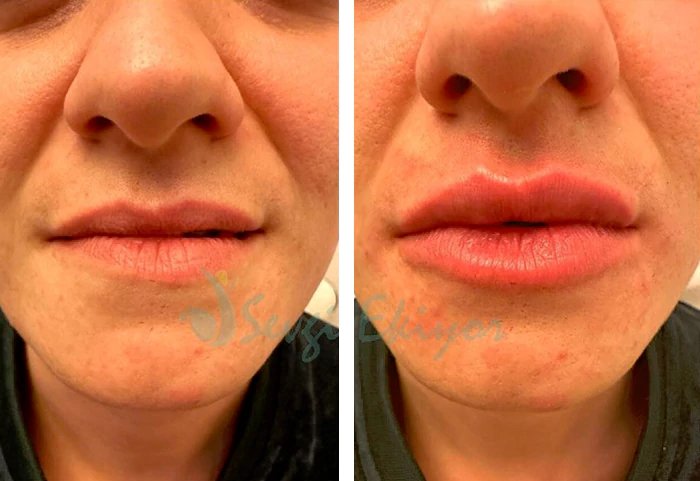 before & after photo of Nose Filler