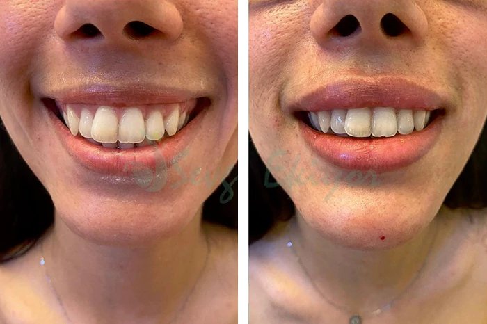 before & after photo of Nose Filler