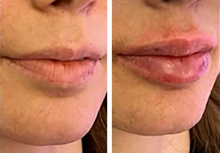 before & after photo of Lip Filler