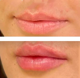 before & after photo of Lip Filler